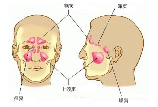 急性鼻窦炎怎么治疗_鼻窦炎的症状及治疗_急性会厌炎怎么治疗