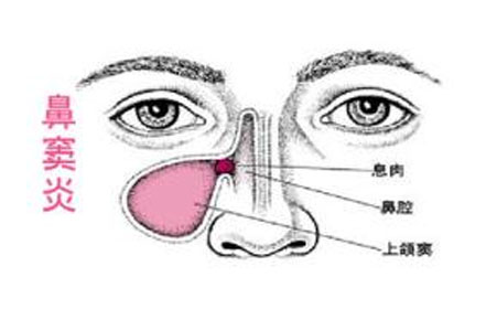 治疗鼻窦炎的医院_鼻炎与鼻窦炎的区别治疗_鼻窦炎治疗方法 鼻窦炎有哪些