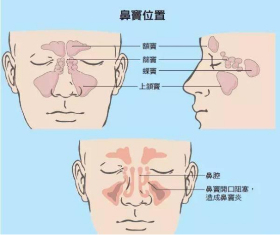 清鼻堂-鼻窦位置