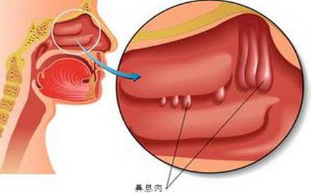 清鼻堂：鼻息肉的症状有哪些？这几种方法请注意收藏！