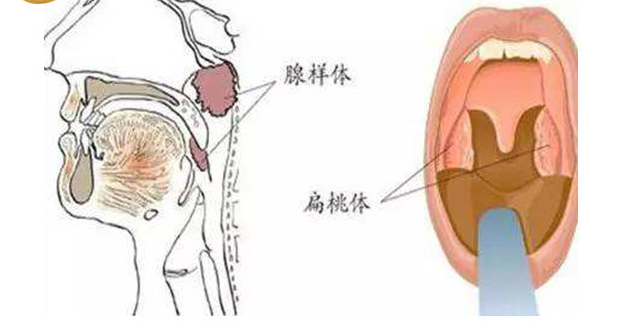 清鼻堂：什么是腺样体肥大？腺样体持续增大会有哪些危害？